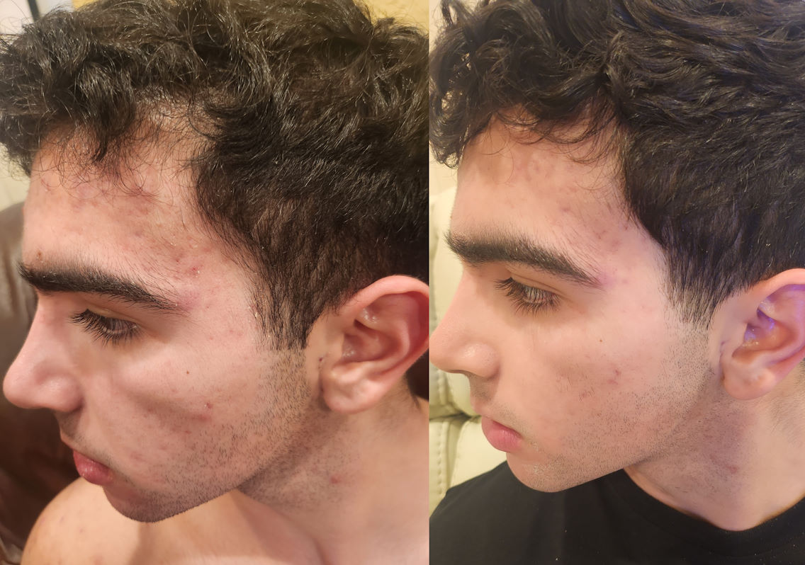 Before and after treatment
