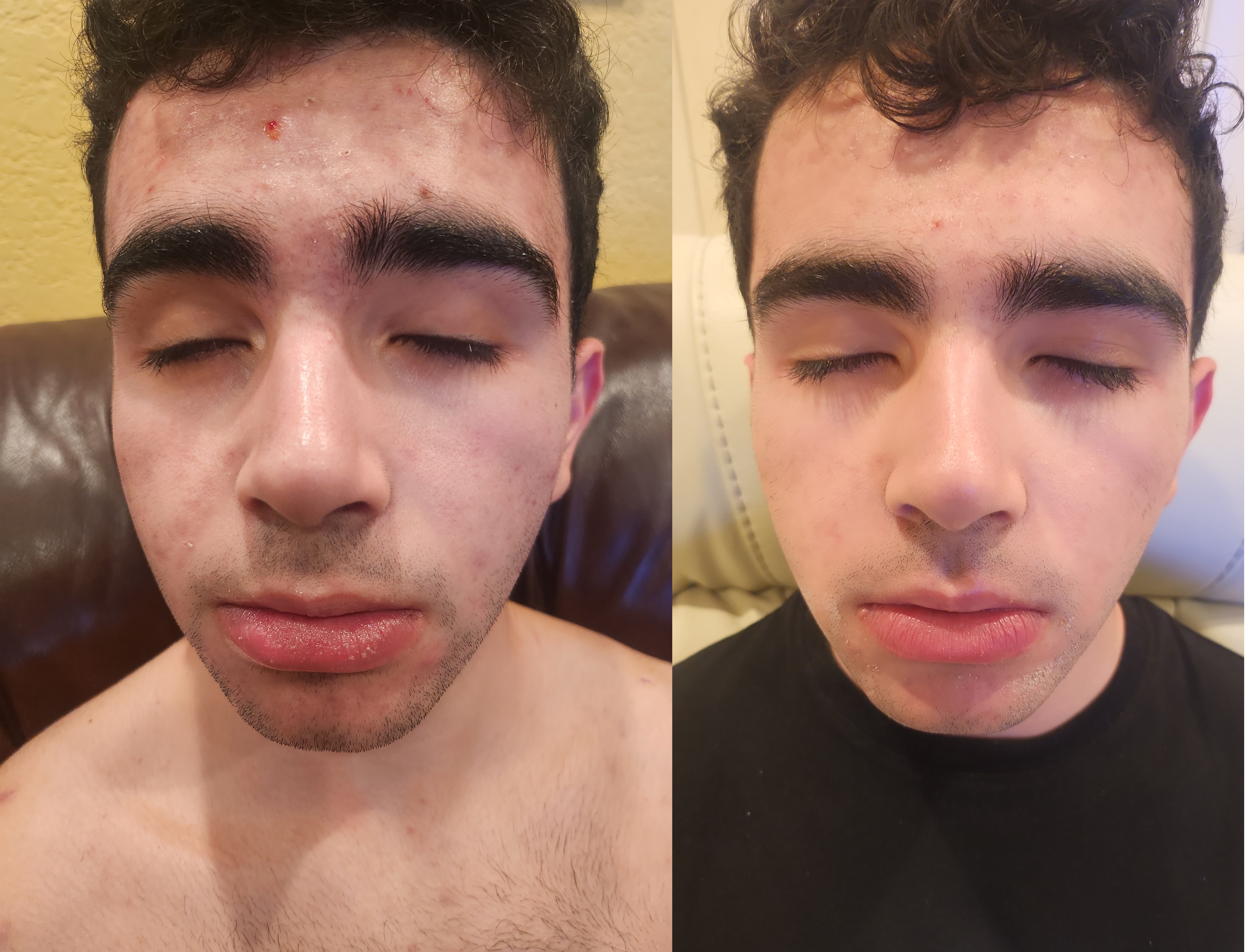 Fia treatment before and after example
