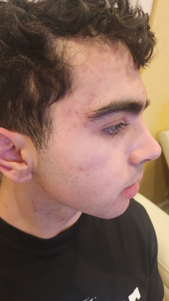 After Fia mask treatment
