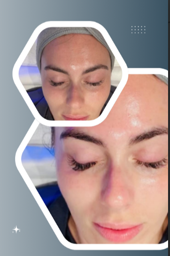 Dark spots fading after treatment