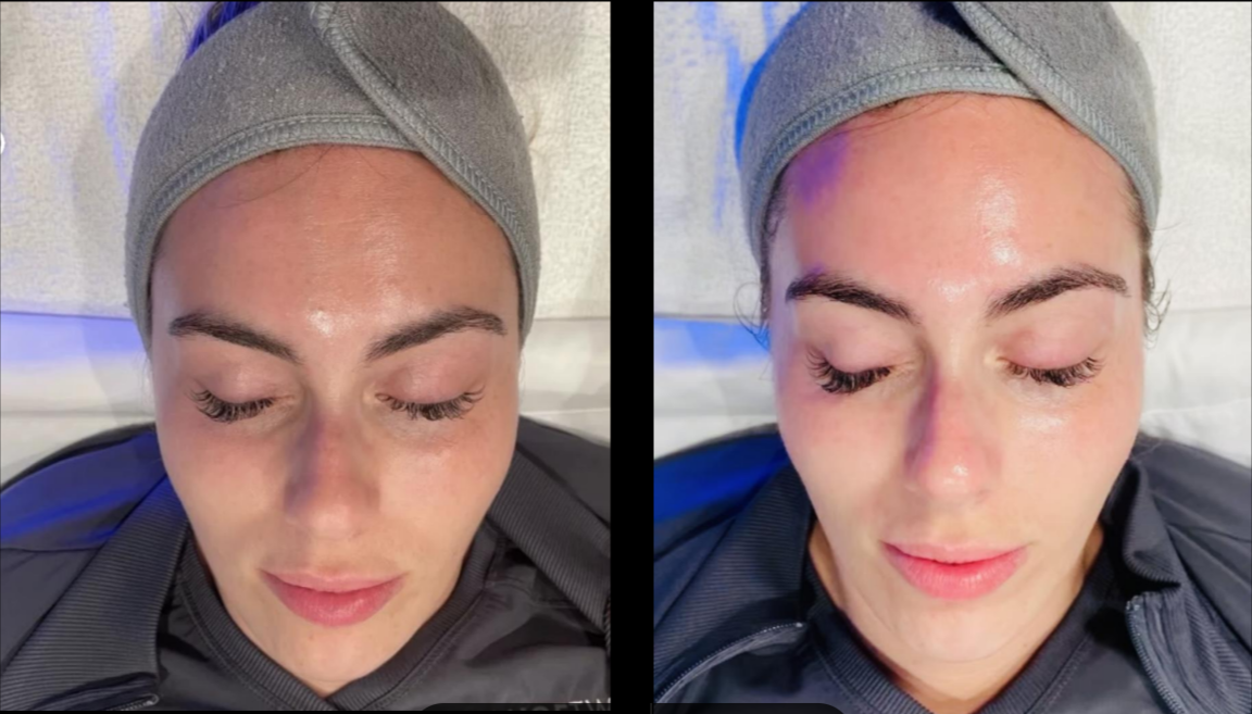 Skin tightening result